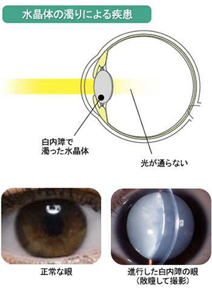 白内障手術入院