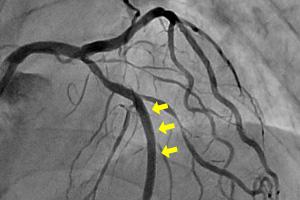 ステント治療後