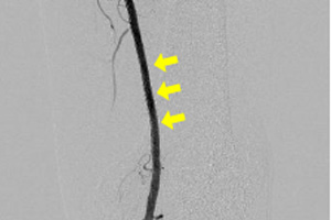 ステント治療後